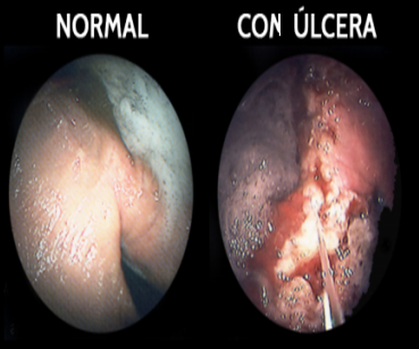 Síndrome de úlcera gástrica en equinos